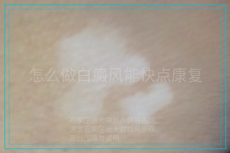 怎么做白癜风能快点康复