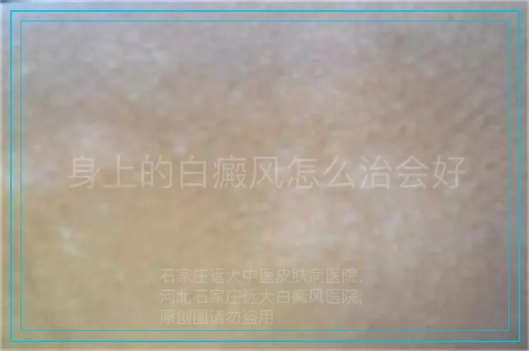 身上的白癜风怎么治会好