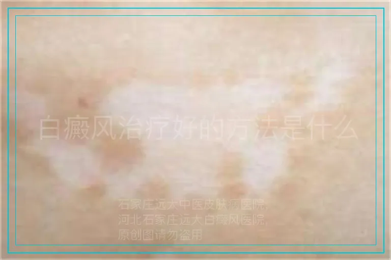 白癜风治疗好的方法是什么