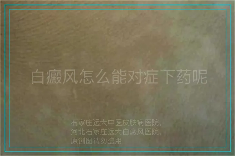 白癜风怎么能对症下药呢