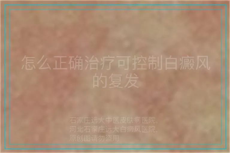 怎么正确治疗可控制白癜风的复发