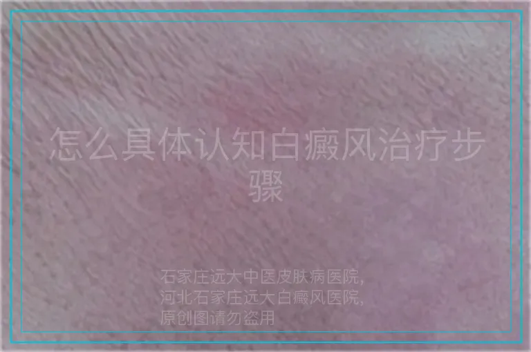 怎么具体认知白癜风治疗步骤