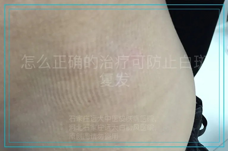 怎么正确的治疗可防止白斑复发