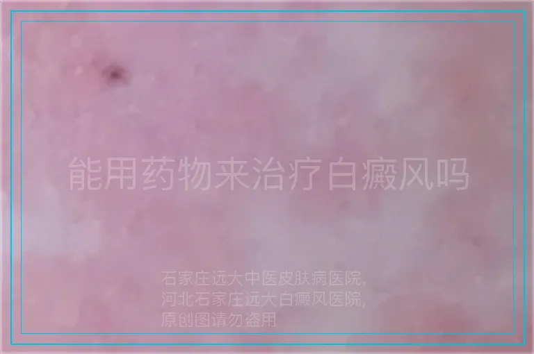 能用药物来治疗白癜风吗