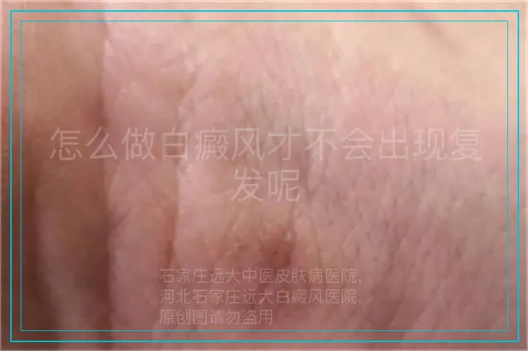 怎么做白癜风才不会出现复发呢