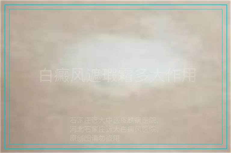 白癜风遮瑕霜多大作用