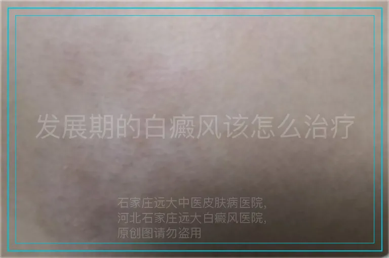 发展期的白癜风该怎么治疗