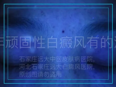 多年顽固性白癜风有的治么