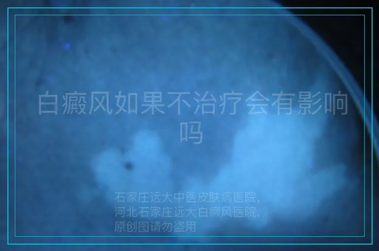 白癜风如果不治疗会有影响吗