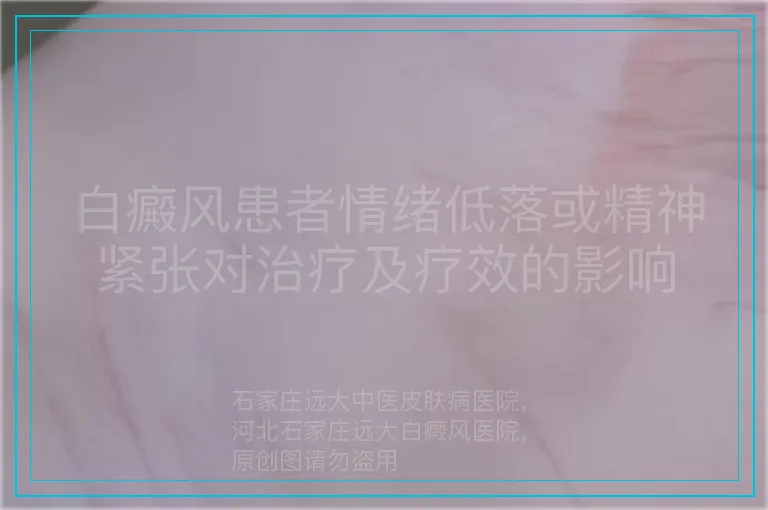 白癜风患者情绪低落或精神紧张对治疗及疗效的影响