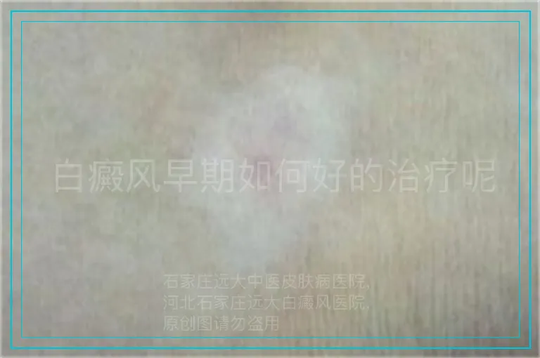 白癜风早期如何好的治疗呢