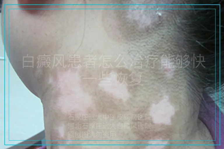 白癜风患者怎么治疗能够快一些恢复
