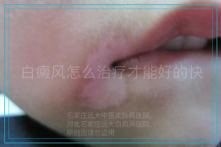 白癜风怎么治疗才能好的快
