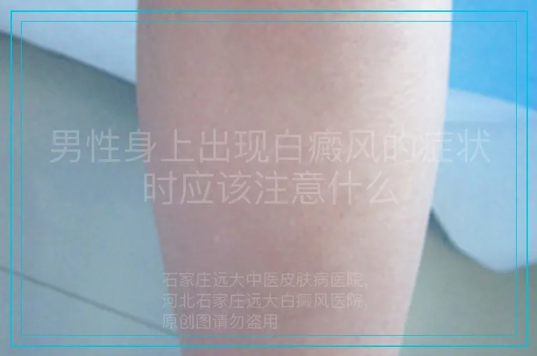 男性身上出现白癜风的症状时应该注意什么