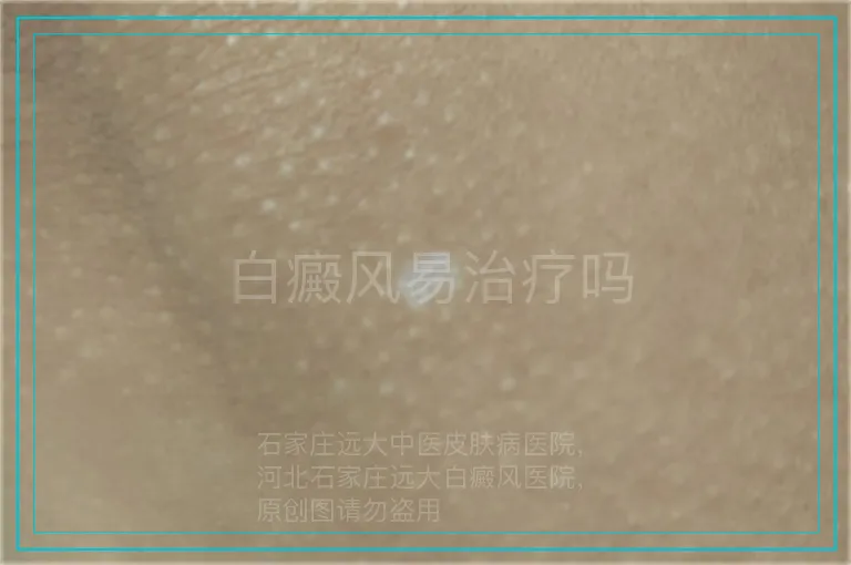 白癜风易治疗吗