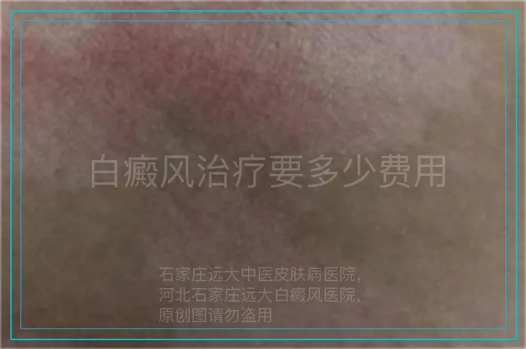 白癜风治疗要多少费用