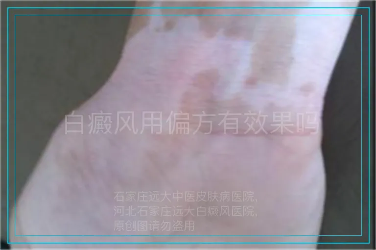 白癜风用偏方有效果吗