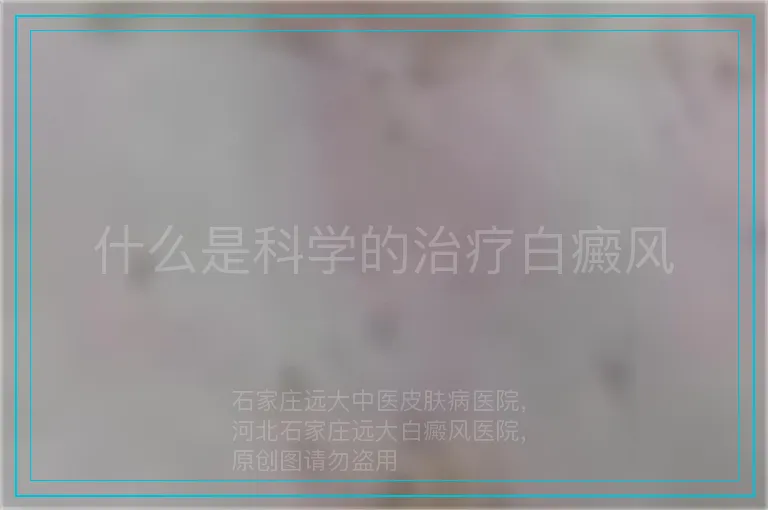 什么是科学的治疗白癜风