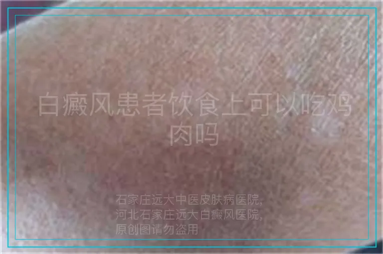 白癜风患者饮食上可以吃鸡肉吗
