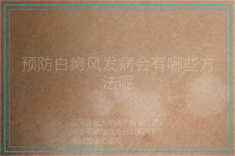 预防白癜风发病会有哪些方法呢
