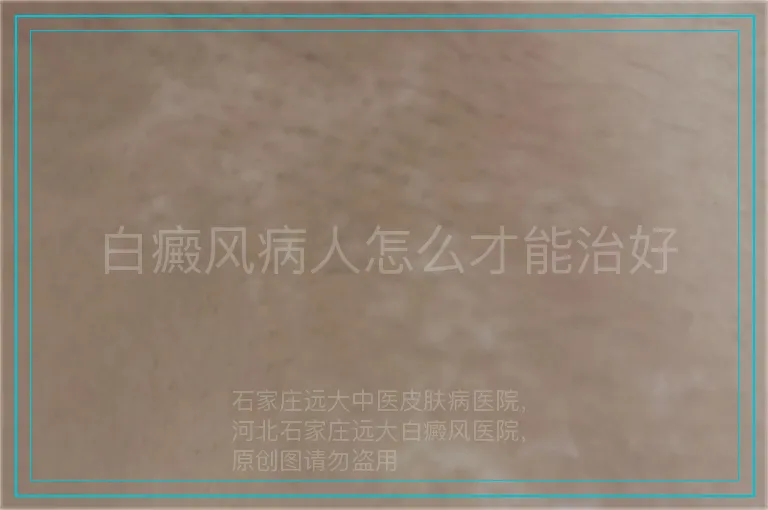 白癜风病人怎么才能治好