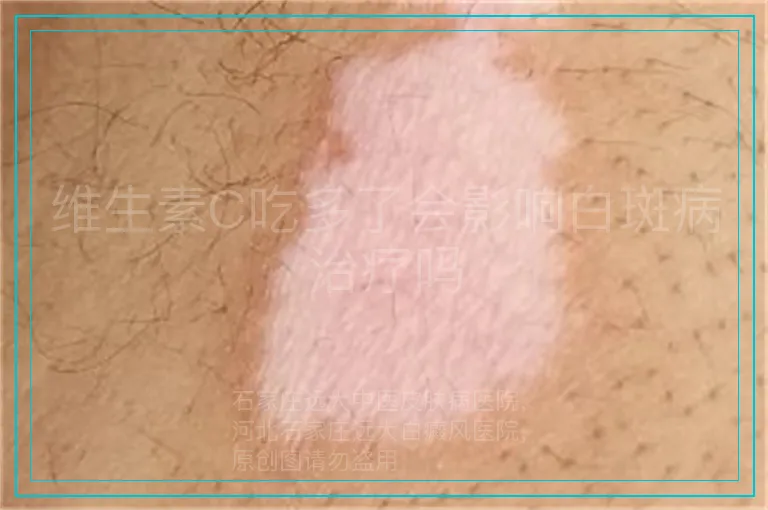 维生素C吃多了会影响白斑病治疗吗