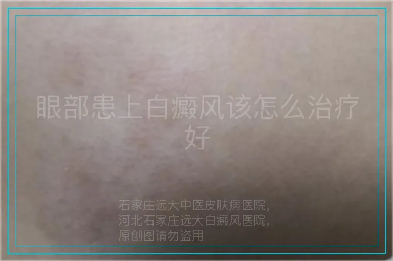 眼部患上白癜风该怎么治疗好