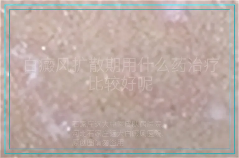 白癜风扩散期用什么药治疗比较好呢