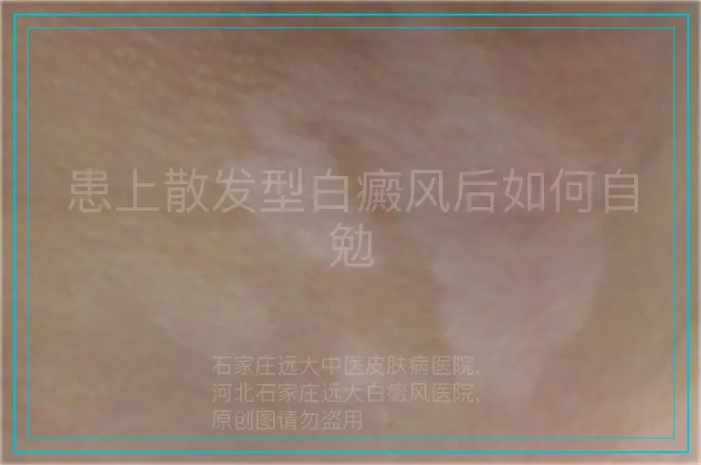 患上散发型白癜风后如何自勉