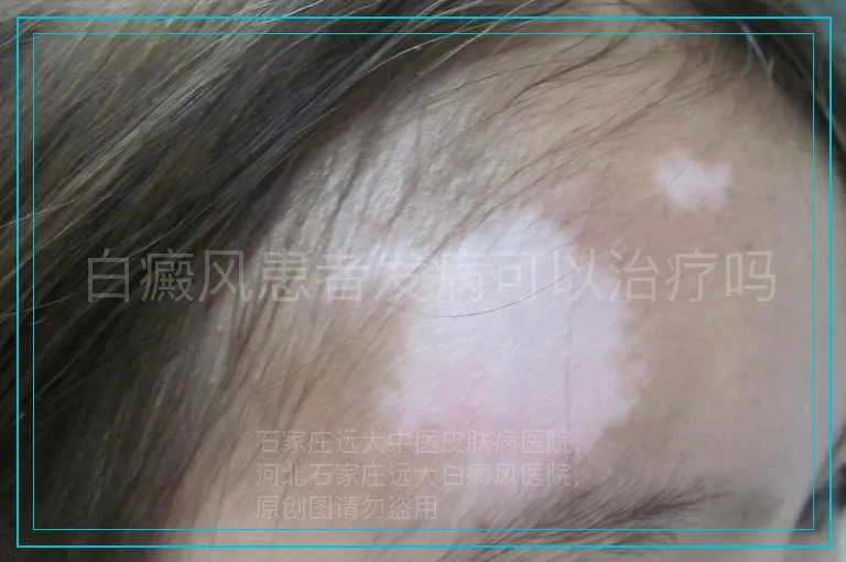 白癜风患者发病可以治疗吗