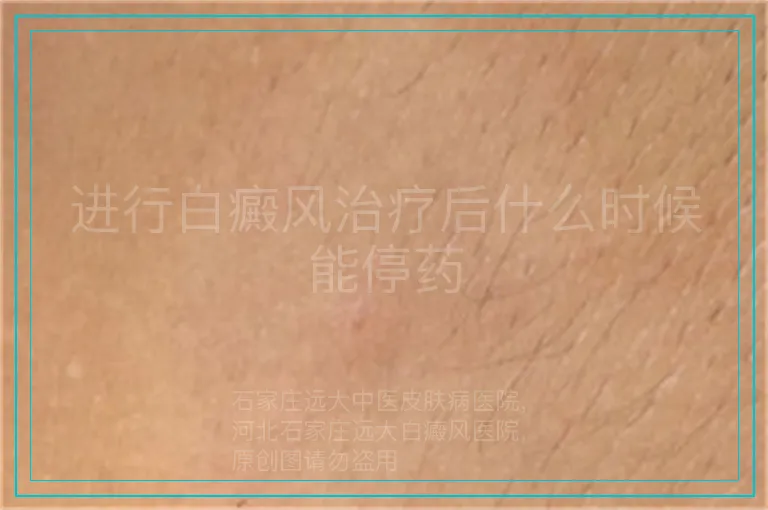 进行白癜风治疗后什么时候能停药