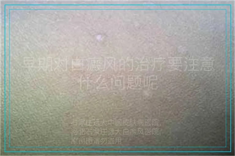 早期对白癜风的治疗要注意什么问题呢
