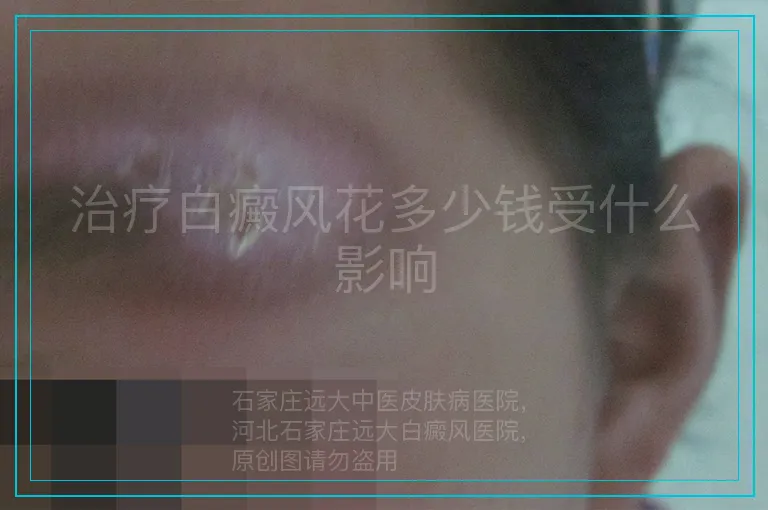 治疗白癜风花多少钱受什么影响
