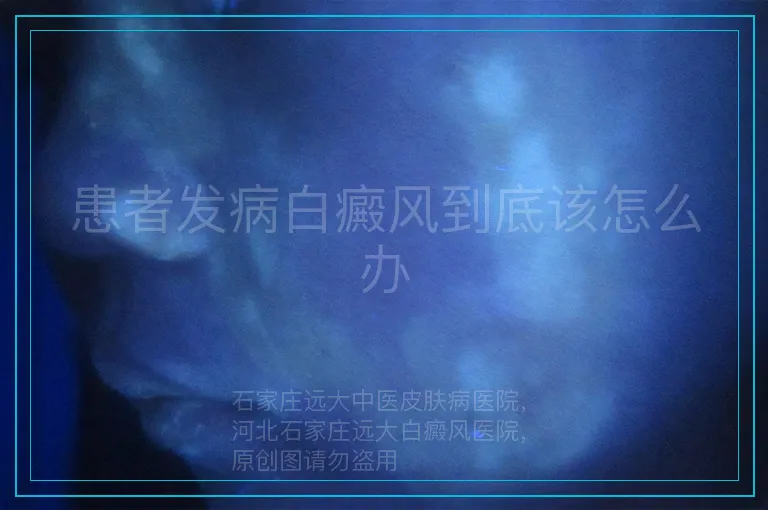 患者发病白癜风到底该怎么办