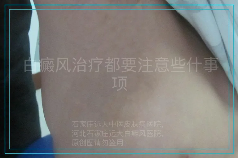 白癜风治疗都要注意些什事项