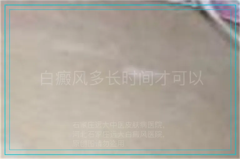 白癜风多长时间才可以