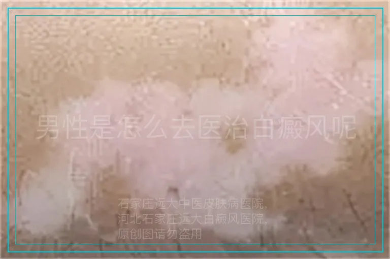 男性是怎么去医治白癜风呢