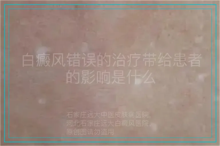 白癜风错误的治疗带给患者的影响是什么