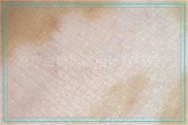 治疗白癜风能用什么特效药