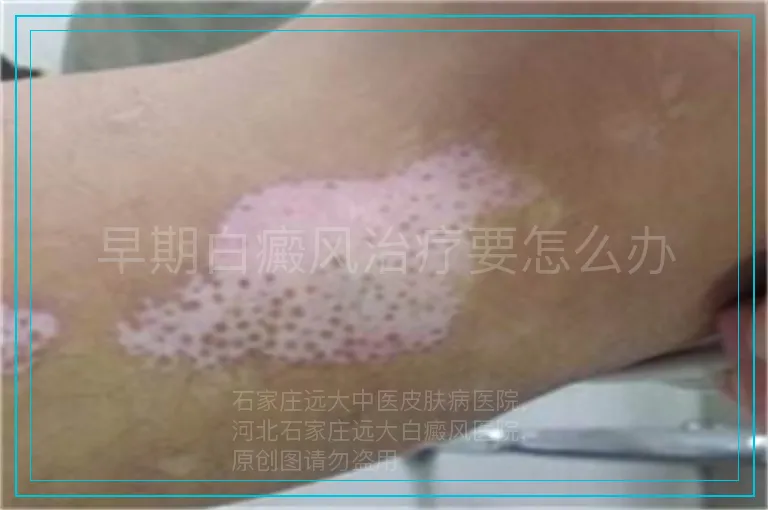 早期白癜风治疗要怎么办