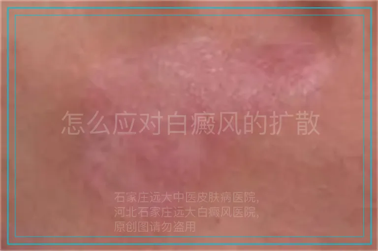 怎么应对白癜风的扩散