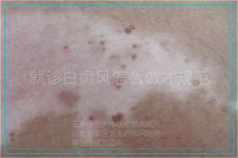 就诊白癜风怎么做才规范