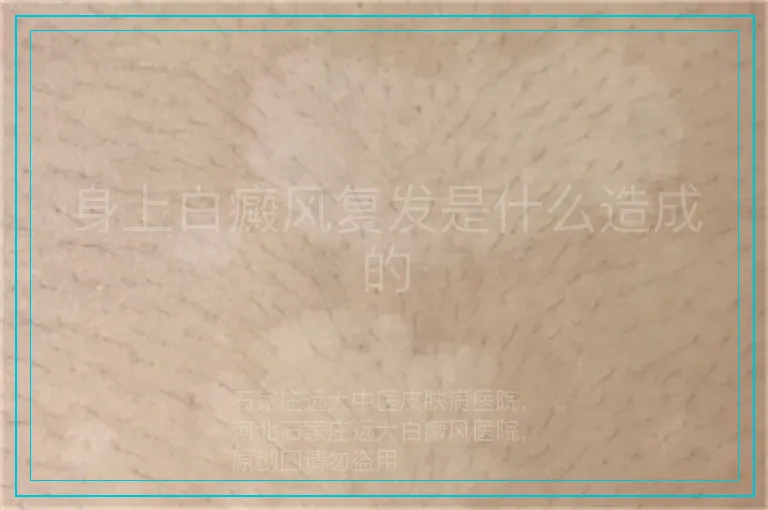 身上白癜风复发是什么造成的