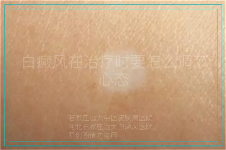 白癜风在治疗时要怎么调节心态