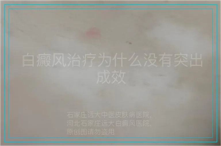 白癜风治疗为什么没有突出成效