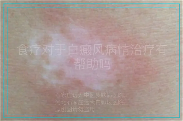 食疗对于白癜风病情治疗有帮助吗
