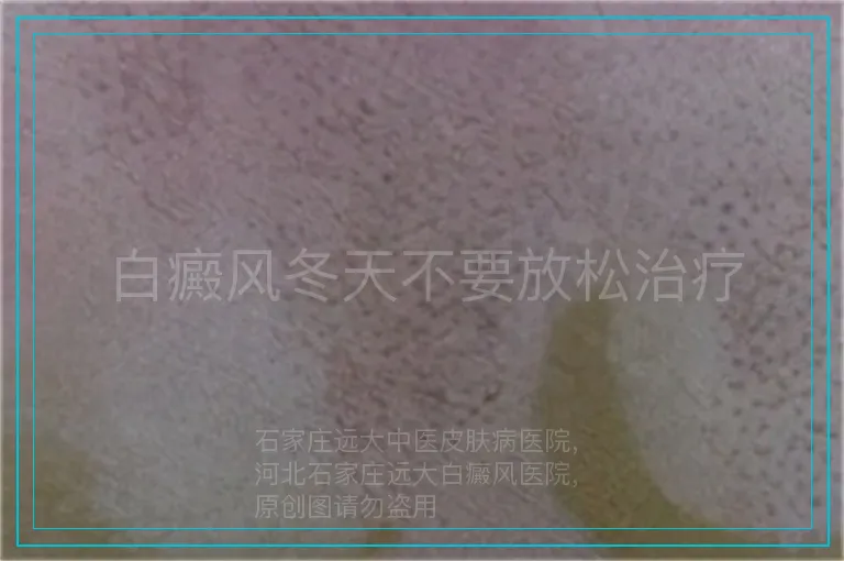白癜风冬天不要放松治疗