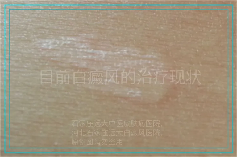 目前白癜风的治疗现状