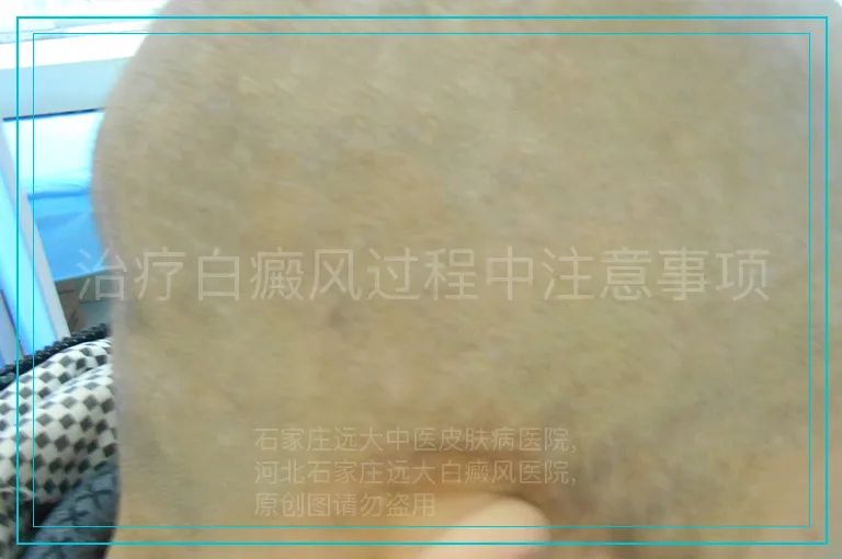 治疗白癜风过程中注意事项