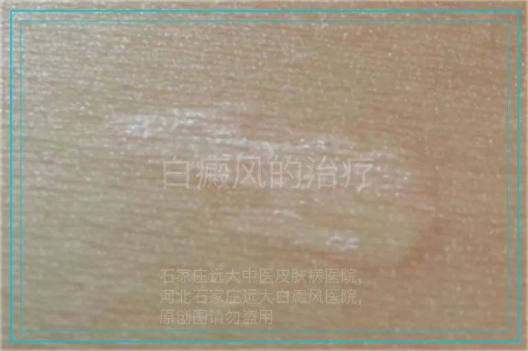 白癜风的治疗